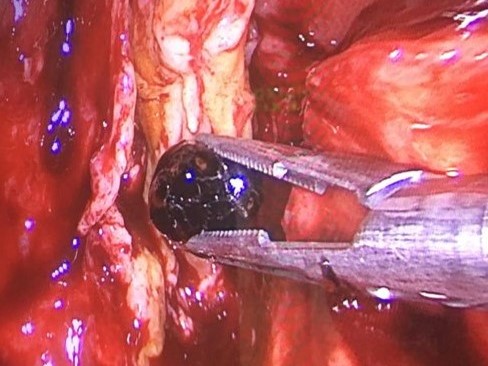 Операция при желчнокаменной болезни 