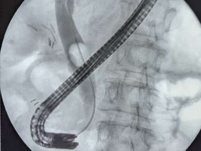 Операция при желчнокаменной болезни 