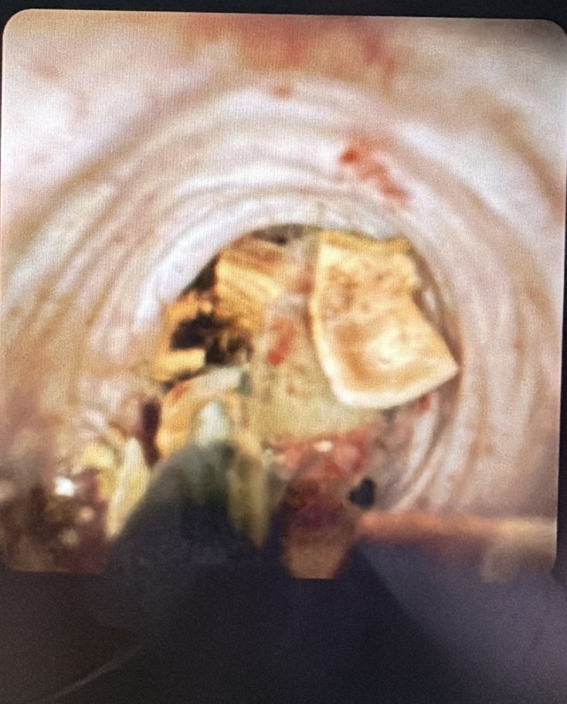 Инновационные технологии дробления и удаления конкрементов поджелудочной железы