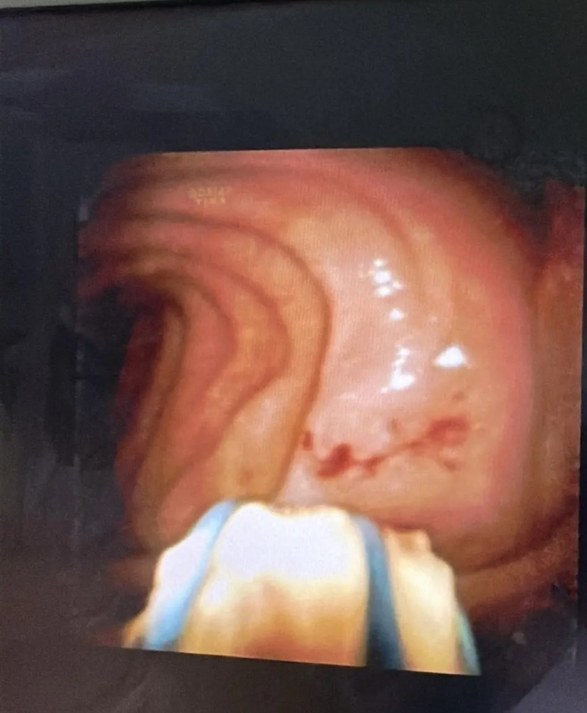 Инновационные технологии дробления и удаления конкрементов поджелудочной железы