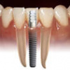 implant